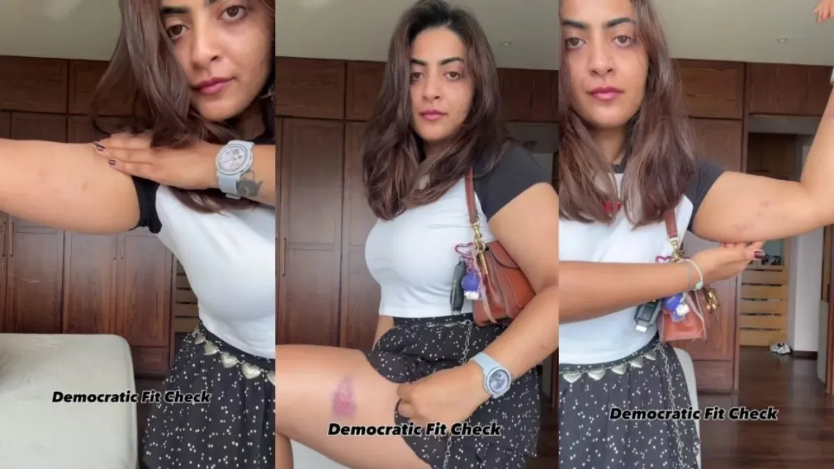Zayn Marie showing bruises on her arm after a protest.